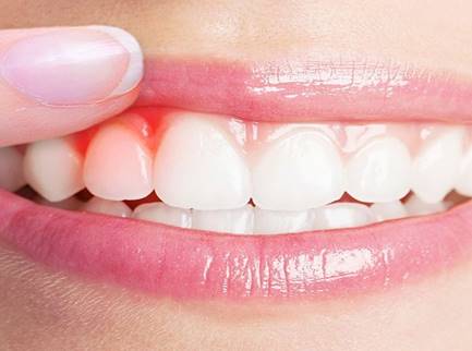 Gum Disease