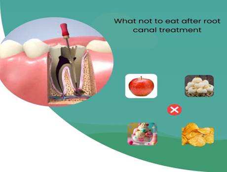 Root Canal Treatment